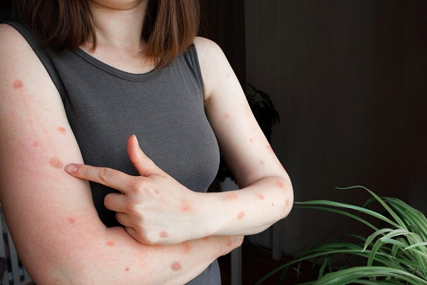 Alergia ou intolerância: como diferenciar essas reações a alimentos?